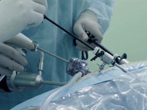 لاپاراسکوپی-