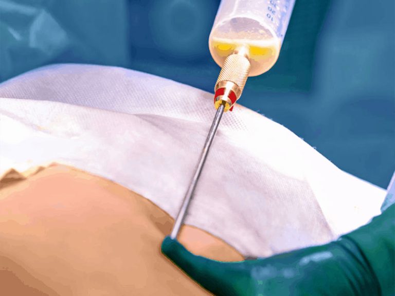 تزریق-چربی-به-بدن-