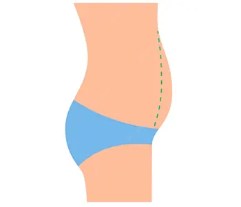 سفت شدن شکم بعد ابدومینوپلاستی