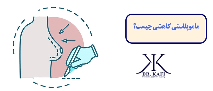 ماموپلاستی کاهشی