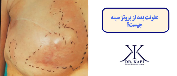 عفونت بعد از پروتز سینه چیست؟